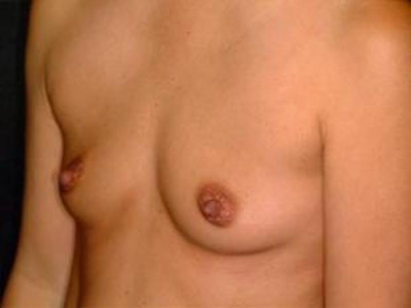 Breast Augmentation Before & After Gallery - Patient 262731 - Image 1
