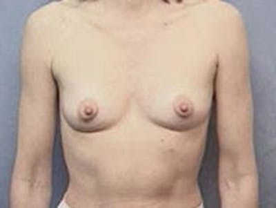 Breast Augmentation Before & After Gallery - Patient 244346 - Image 1
