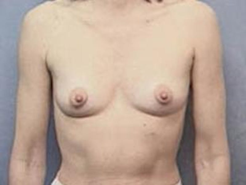 Breast Augmentation Before & After Gallery - Patient 244346 - Image 1