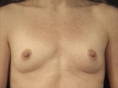 Breast Augmentation Before & After Gallery - Patient 299112 - Image 1