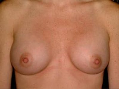 Breast Augmentation Before & After Gallery - Patient 299112 - Image 2