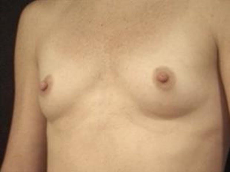 Breast Augmentation Before & After Gallery - Patient 299112 - Image 3