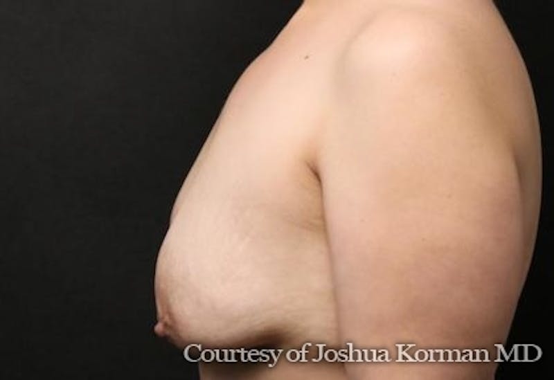 Breast Lift Before & After Gallery - Patient 121599 - Image 3