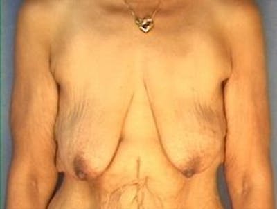 Breast Lift Before & After Gallery - Patient 105710 - Image 1