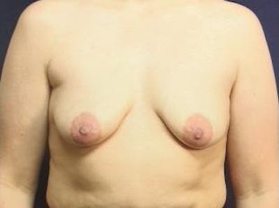 Breast Lift Before & After Gallery - Patient 404629 - Image 1