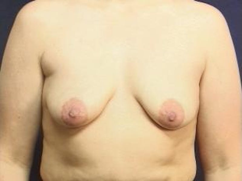 Breast Lift Before & After Gallery - Patient 404629 - Image 1