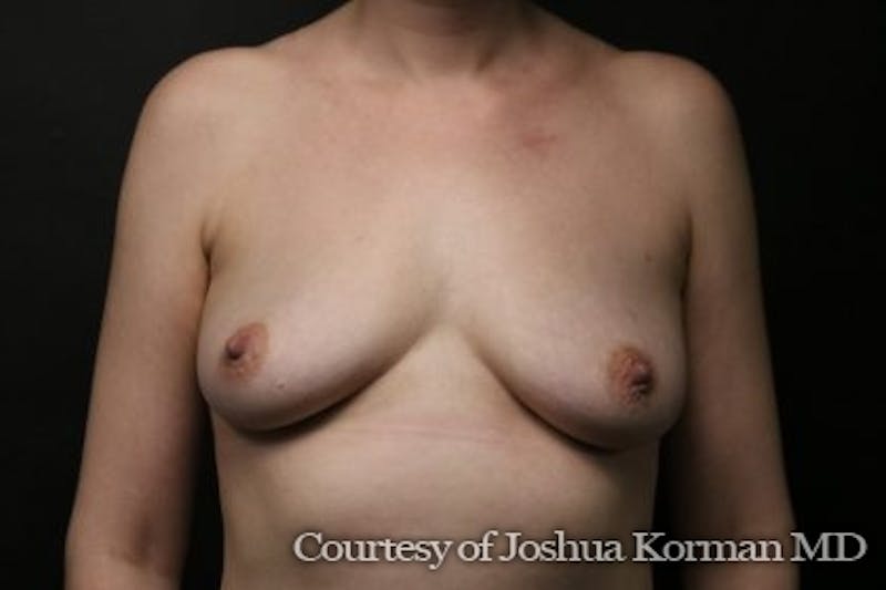 Breast Reconstruction Before & After Gallery - Patient 127455 - Image 1