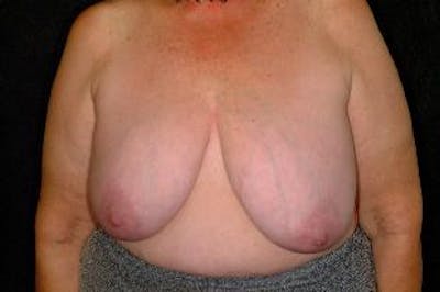 Breast Reconstruction Before & After Gallery - Patient 181734 - Image 1