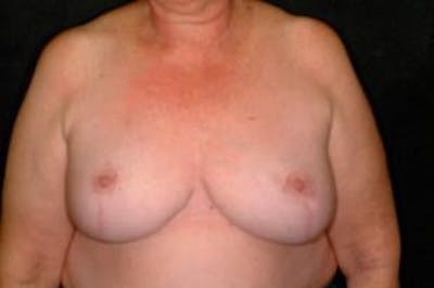 Breast Reconstruction Before & After Gallery - Patient 181734 - Image 2