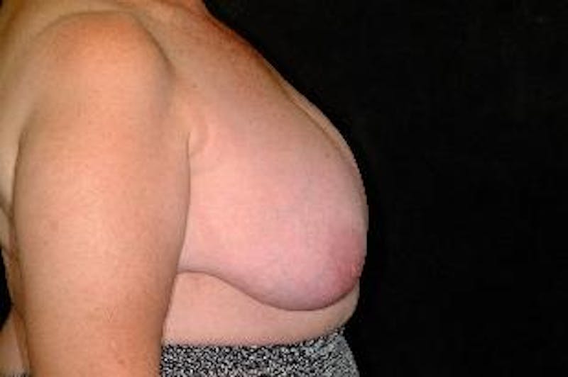 Breast Reconstruction Before & After Gallery - Patient 181734 - Image 3