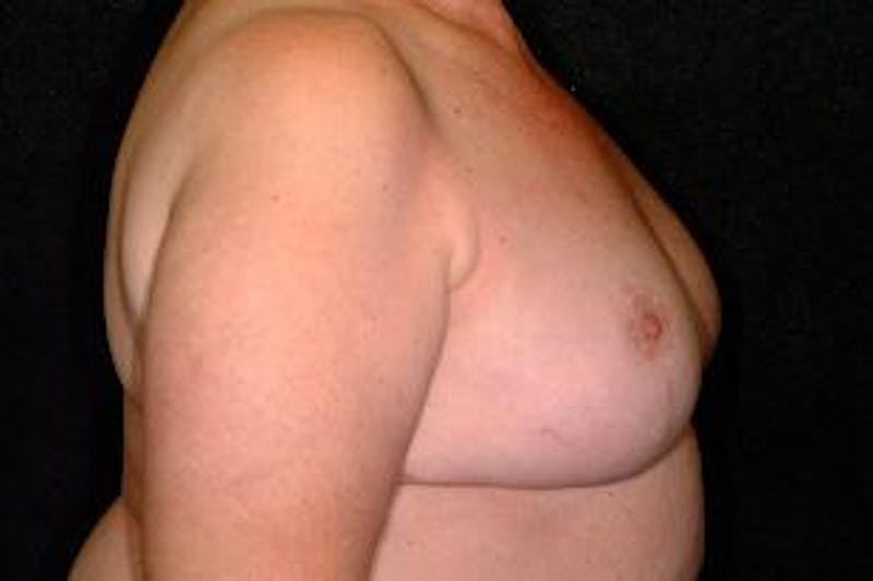 Breast Reconstruction Before & After Gallery - Patient 181734 - Image 4