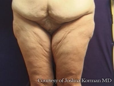 Thigh Lift Before & After Gallery - Patient 296081 - Image 1
