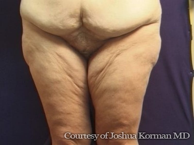 Thigh Lift Before & After Gallery - Patient 296081 - Image 1