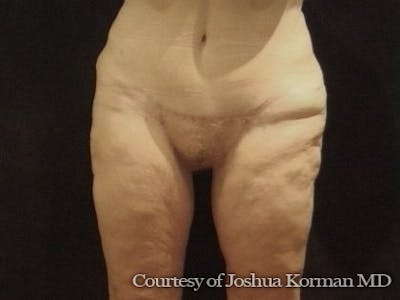 Thigh Lift Before & After Gallery - Patient 296081 - Image 2