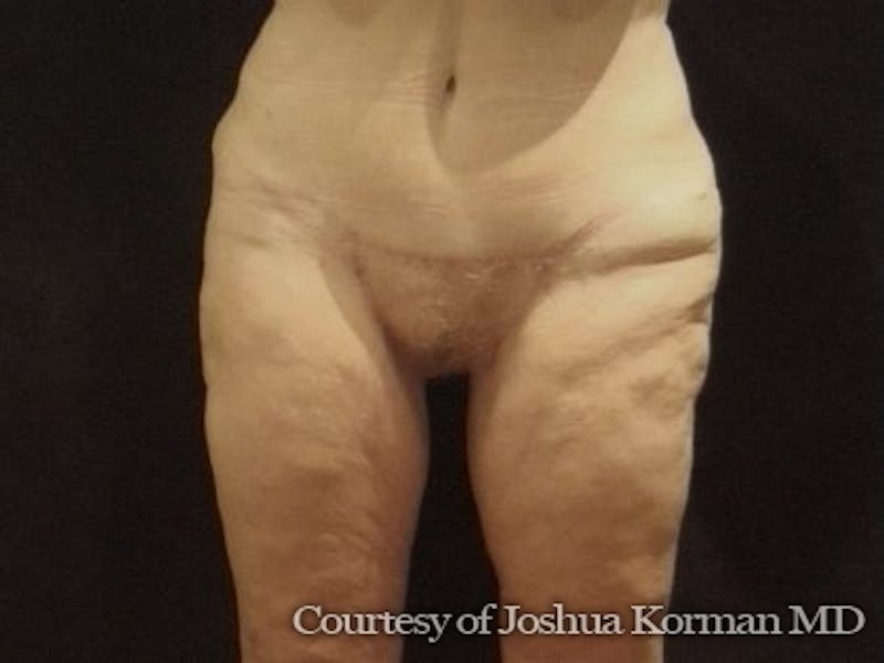 Thigh Lift Before & After Gallery - Patient 296081 - Image 2