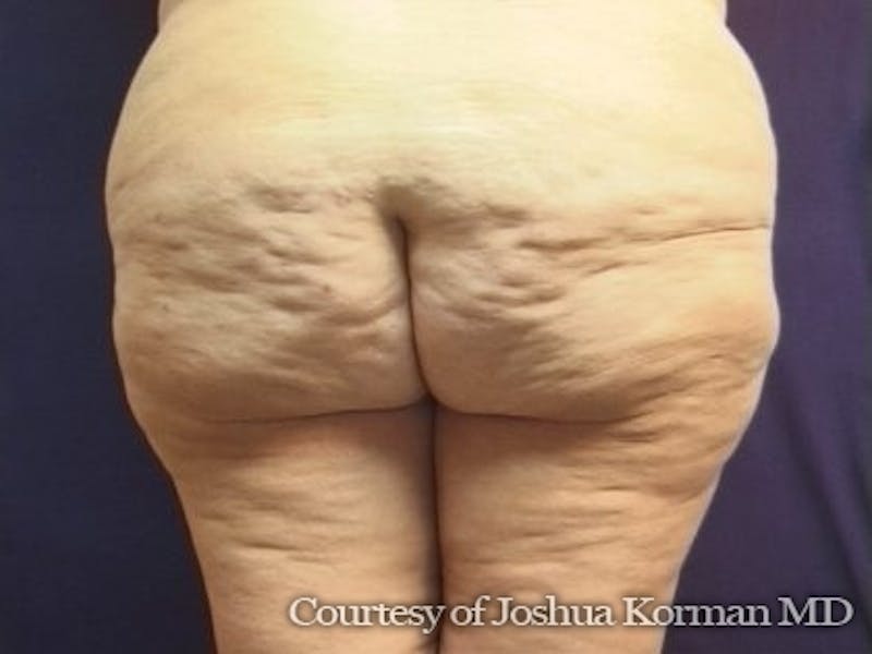 Thigh Lift Before & After Gallery - Patient 296081 - Image 3