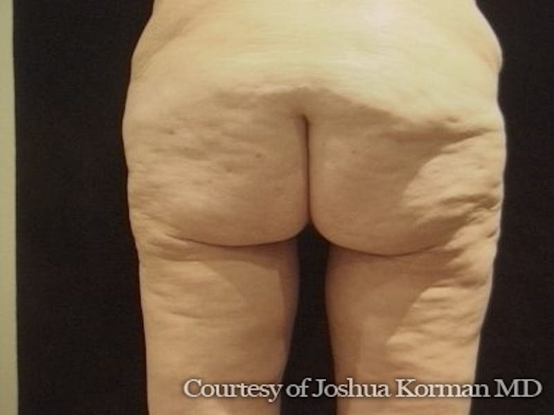 Thigh Lift Before & After Gallery - Patient 296081 - Image 4