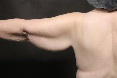 Arm Lift Before & After Gallery - Patient 354357 - Image 1