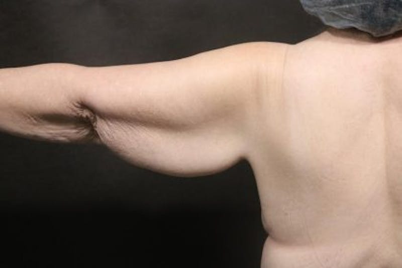 Arm Lift Before & After Gallery - Patient 354357 - Image 1