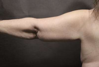 Arm Lift Before & After Gallery - Patient 354357 - Image 2