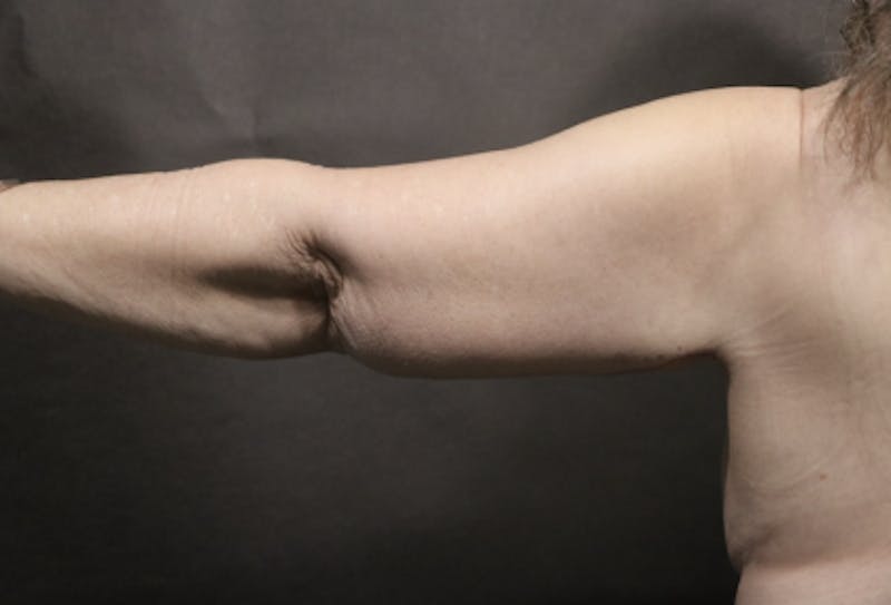 Arm Lift Before & After Gallery - Patient 354357 - Image 2
