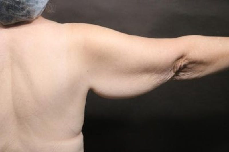 Arm Lift Before & After Gallery - Patient 354357 - Image 3
