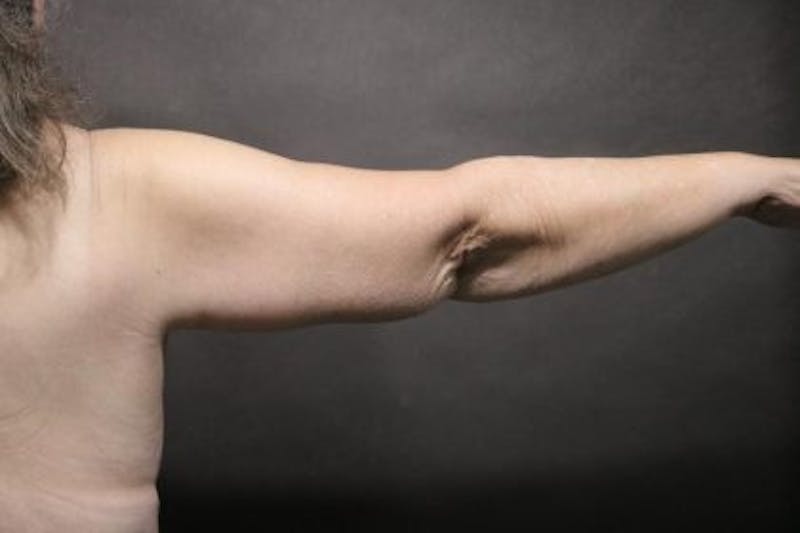 Arm Lift Before & After Gallery - Patient 354357 - Image 4