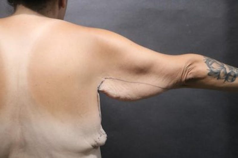 Arm Lift Before & After Gallery - Patient 386111 - Image 1