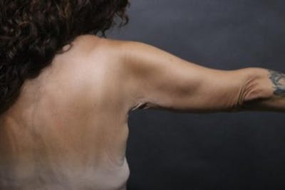 Arm Lift Before & After Gallery - Patient 386111 - Image 2