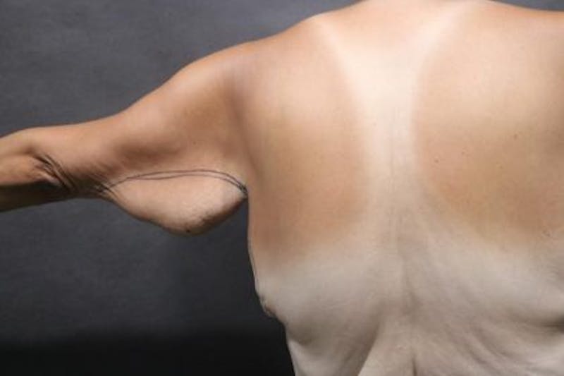 Arm Lift Before & After Gallery - Patient 386111 - Image 3