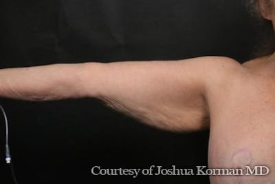 Arm Lift Before & After Gallery - Patient 135301 - Image 1