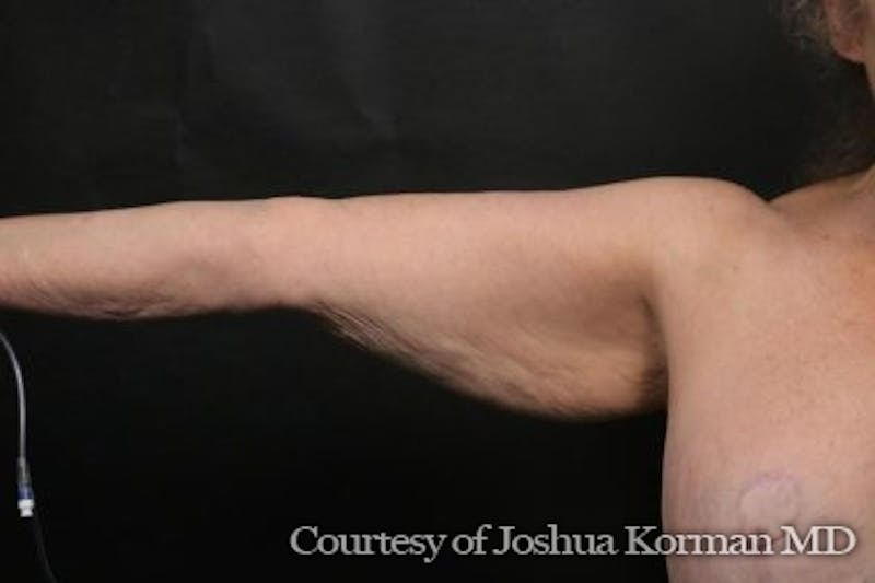 Arm Lift Before & After Gallery - Patient 135301 - Image 1