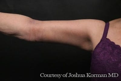 Arm Lift Before & After Gallery - Patient 135301 - Image 2