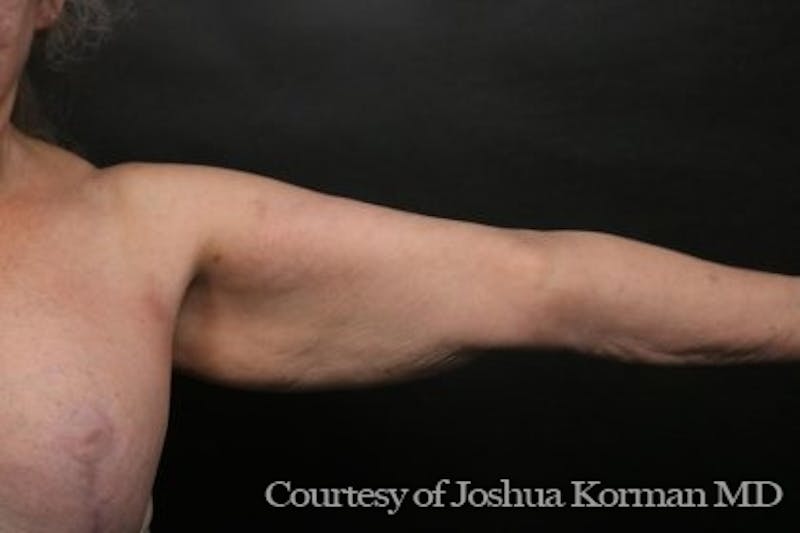 Arm Lift Before & After Gallery - Patient 135301 - Image 3
