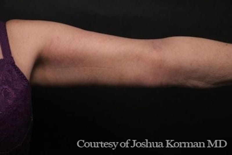 Arm Lift Before & After Gallery - Patient 135301 - Image 4