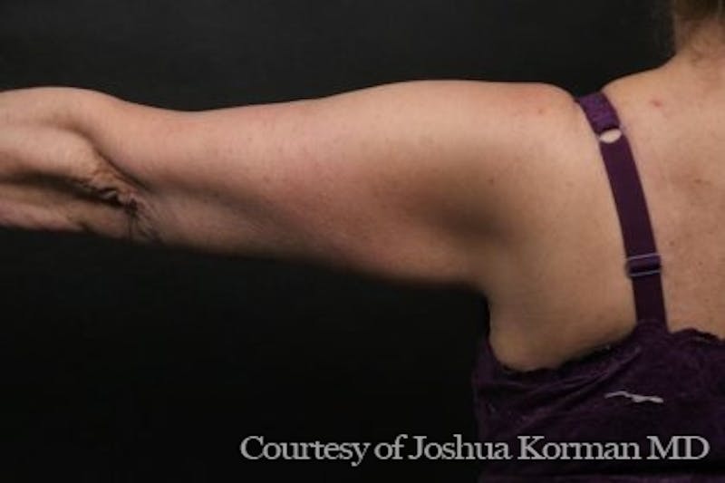 Arm Lift Before & After Gallery - Patient 135301 - Image 6