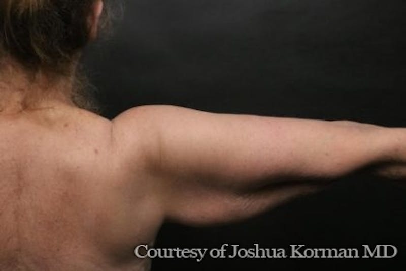 Arm Lift Before & After Gallery - Patient 135301 - Image 7