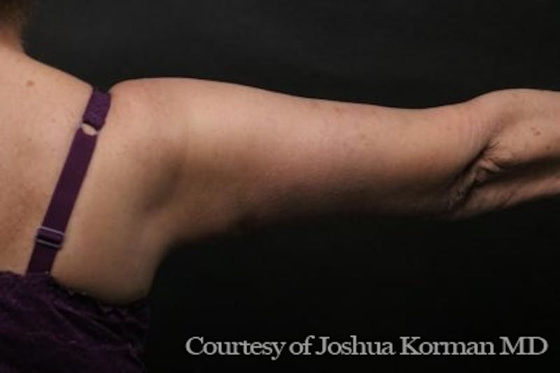 Arm Lift Before & After Gallery - Patient 135301 - Image 8