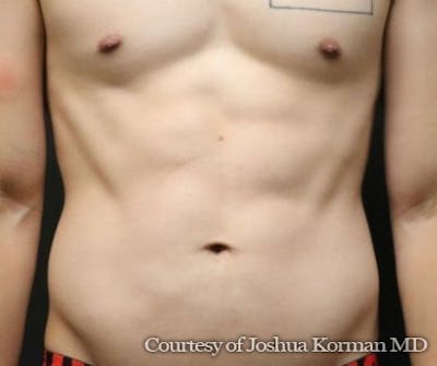 EmSculpt Neo Before & After Gallery - Patient 107062 - Image 2