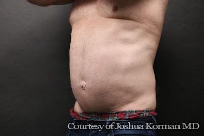 EmSculpt Neo Before & After Gallery - Patient 332534 - Image 1