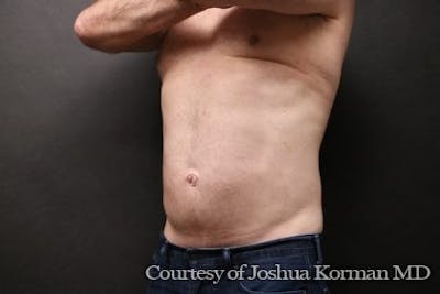 EmSculpt Neo Before & After Gallery - Patient 332534 - Image 2