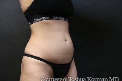 EmSculpt Neo Before & After Gallery - Patient 194579 - Image 1