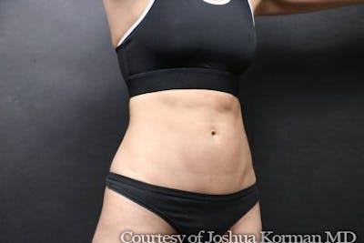 EmSculpt Neo Before & After Gallery - Patient 194579 - Image 2