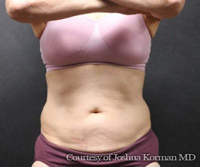 CoolSculpting Before & After Gallery - Patient 926580 - Image 1