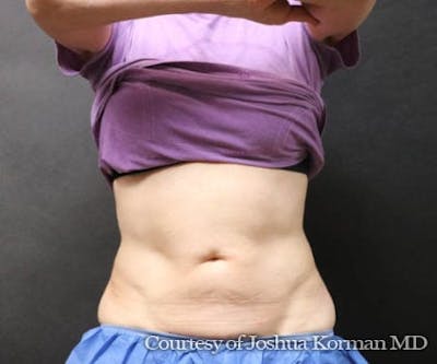 CoolSculpting Before & After Gallery - Patient 926580 - Image 2