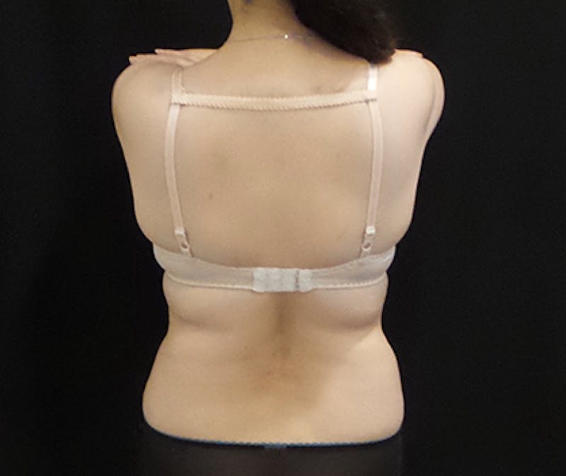 CoolSculpting Before & After Gallery - Patient 396936 - Image 1