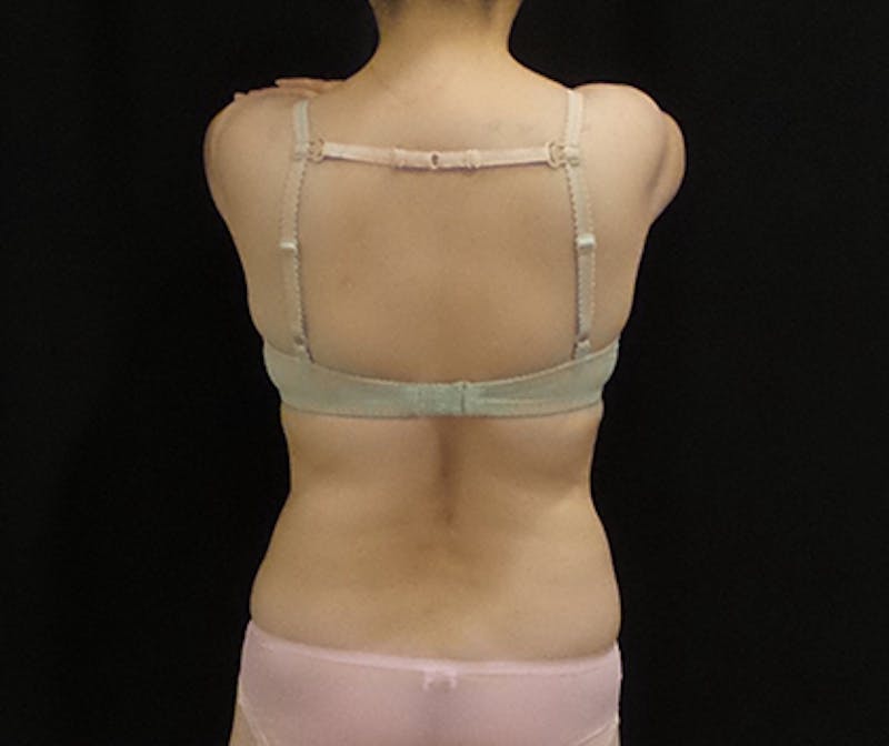 CoolSculpting Before & After Gallery - Patient 396936 - Image 2
