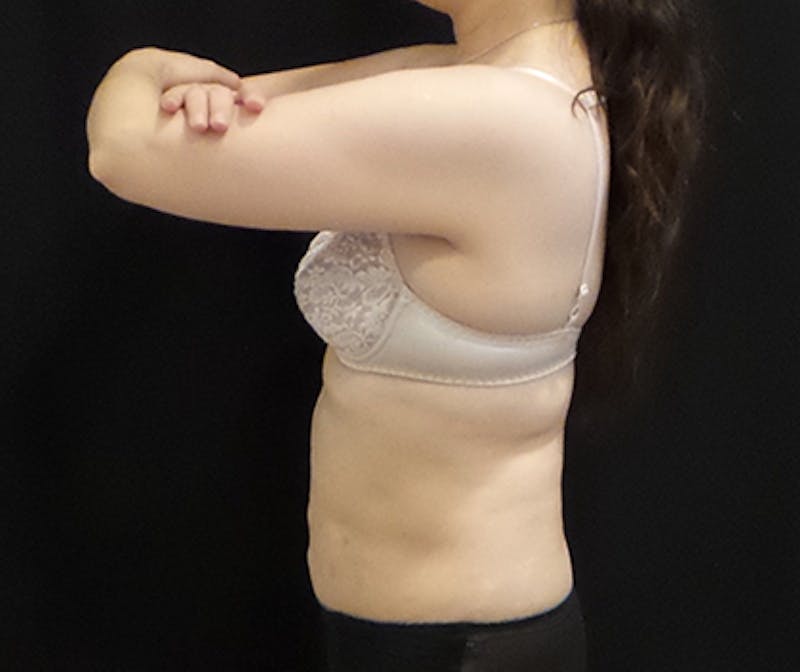 CoolSculpting Before & After Gallery - Patient 396936 - Image 3