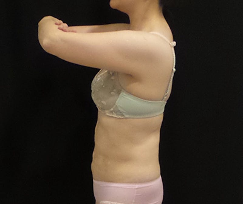 CoolSculpting Before & After Gallery - Patient 396936 - Image 4