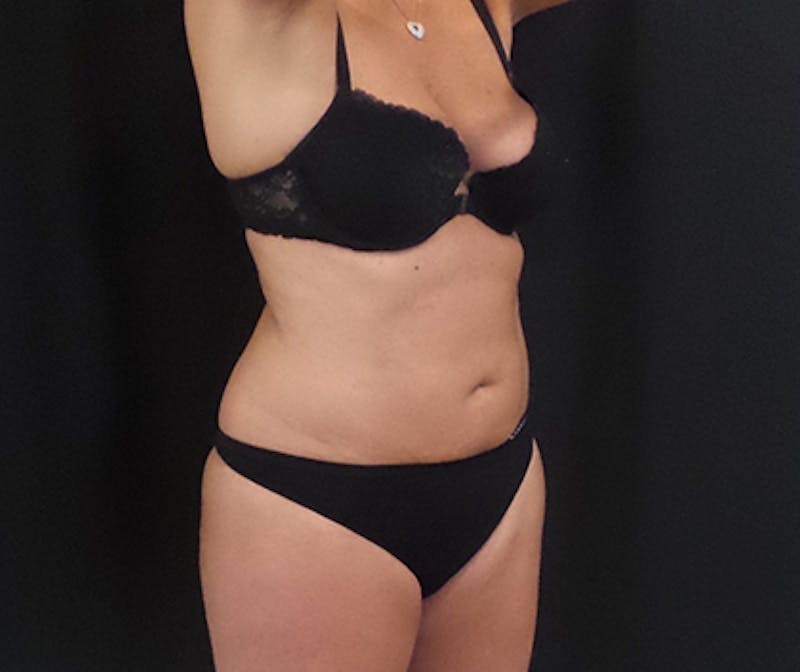 CoolSculpting Before & After Gallery - Patient 113563 - Image 2